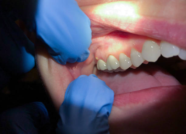 Best Emergency Dental Care for Abscessed Tooth in Ozk, AR