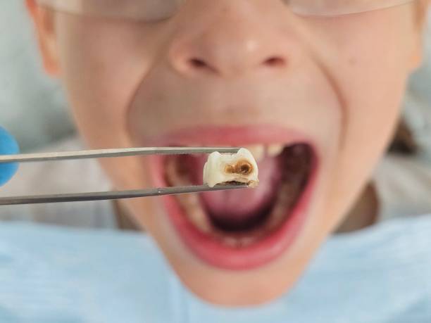 Best Emergency Root Canal Treatment in Ozk, AR